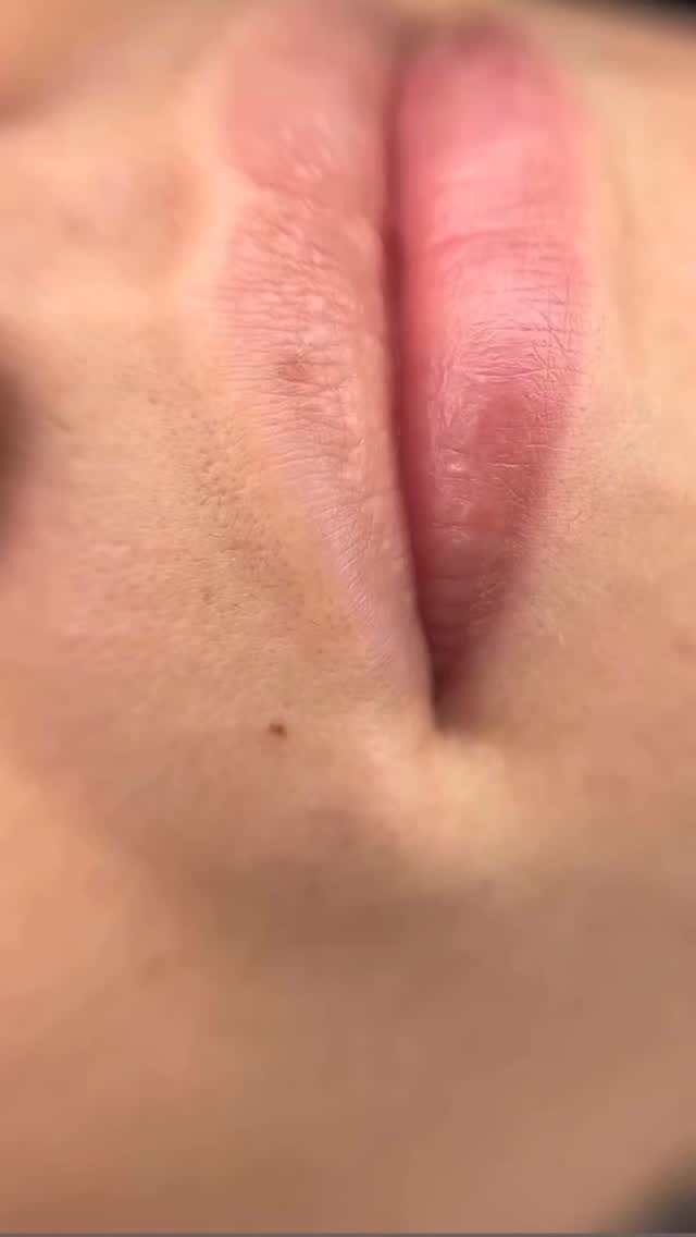 Caso real de Micropigmentación de labios